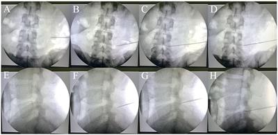 Utilization of a novel patient-specific 3D-printing template for percutaneous endoscopic transforaminal discectomy: results from a randomized controlled trial